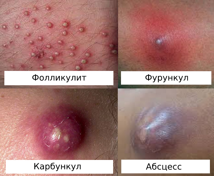 Лечение фурункулеза в Москве - цены